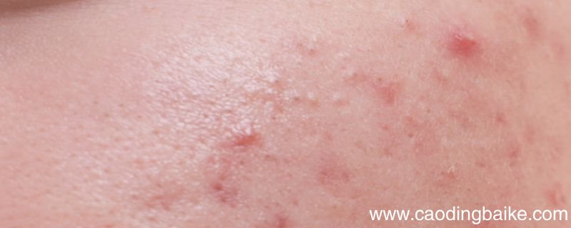 安安粉刺露好用吗 安安粉刺露是什么