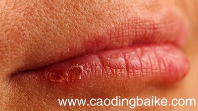 嘴巴干裂出血该如何解决 嘴巴干裂出血怎么办