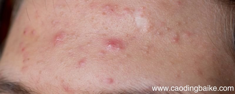 脸上长粉刺怎么办 脸上长粉刺该如何解决