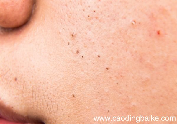 黑头粉刺是什么 黑头粉刺形成的原因