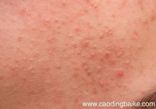 粉刺形成有这些原因 为什么会出现粉刺