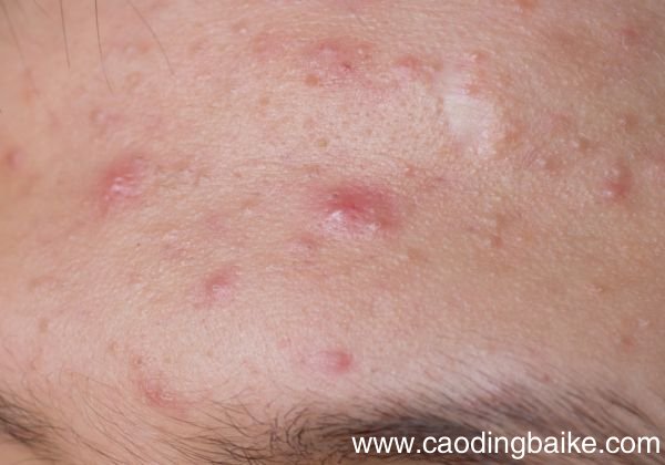 粉刺形成有这些原因 为什么会出现粉刺