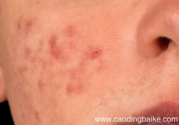 马油皂适合天天洗脸吗马油皂洗脸有什么用