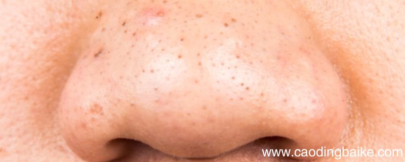 祛除黑头的常见方法 祛黑头的简单小妙招