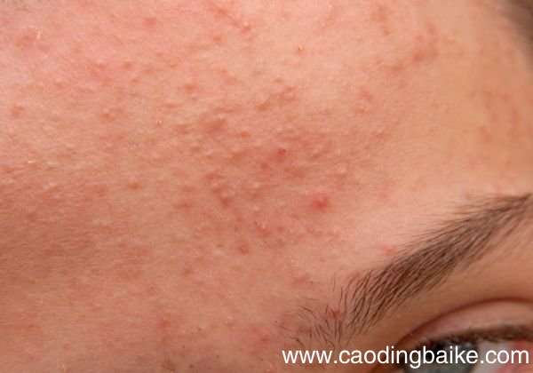 洋甘菊能去痘印吗 洋甘菊有哪些作用