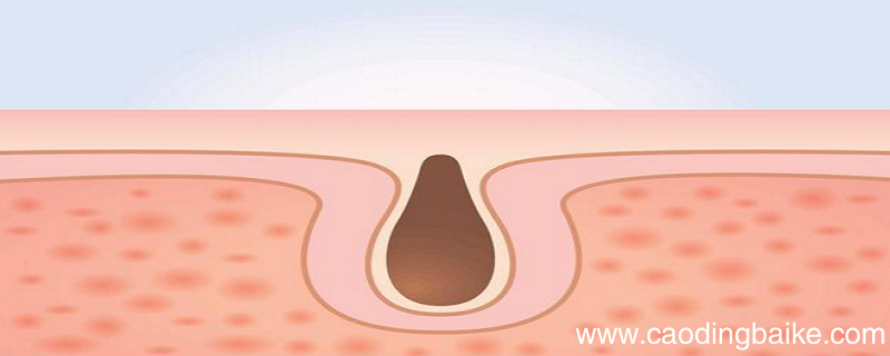 脸上毛孔粗大怎么改善 改善毛孔粗大的小窍门