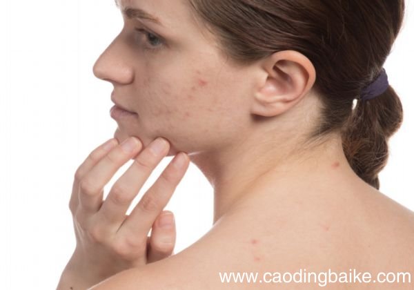 粉刺和痘痘的区别 粉刺和痘痘有什么不同