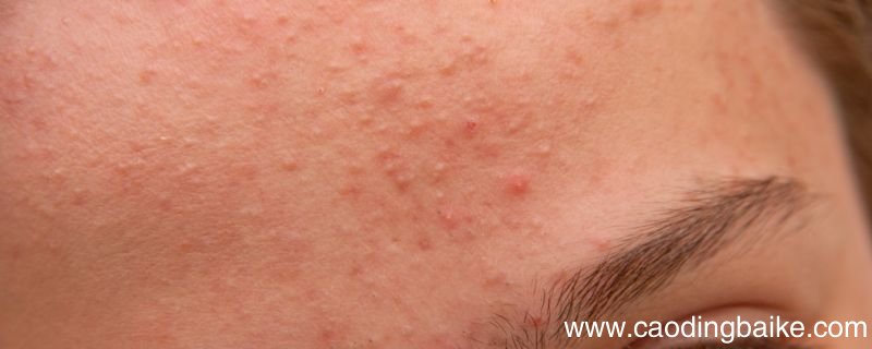 额头上长粉刺怎么办额头长粉刺要怎么做