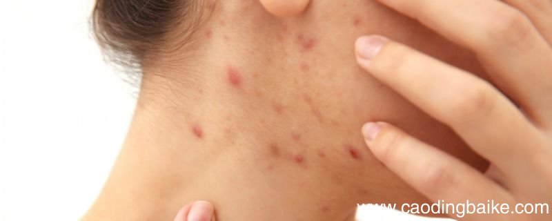 痤疮粉刺怎么治 痤疮粉刺治疗方式