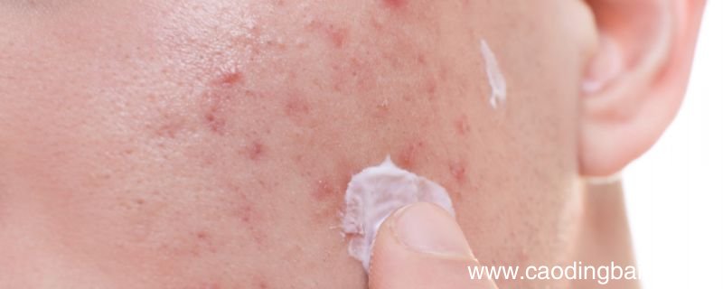 安安粉刺露怎么用安安粉刺露使用方法